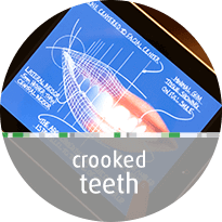 crooked teeth